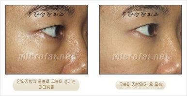 두한성형외과 눈밑수술 - 다크서클 수술 전후 관리 안내 관련 이미지 72