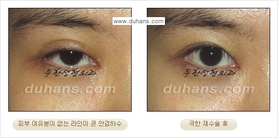 ⁠⁠⁠⁠[두한성형외과 성형 FOCUS] - [정상적인 눈매로의 복원 극한재수술 경우 ①] 관련 이미지 6