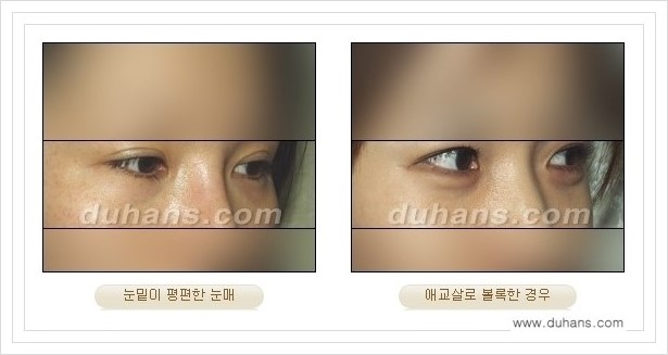 [두한성형외과 경쟁력 눈밑성형] - [눈밑애교살 시술을 위한 미세지방이식] 관련 이미지 1