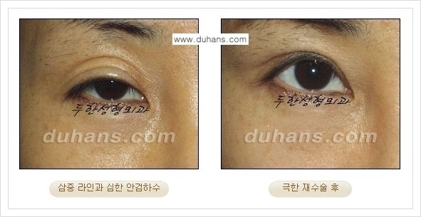 [두한성형외과 경쟁력 망가진 눈 복원수술] - [두꺼운 라인을 교정하는 극한 재수술(Extreme Reoperation) 안내] 관련 이미지 14
