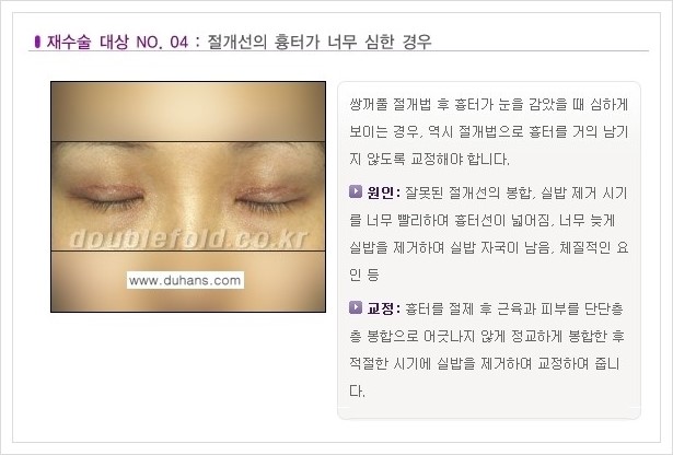 ⁠⁠[두한성형외과 경쟁력 쌍꺼풀 재수술, 극한 재수술] - [쌍꺼풀 재수술이 필요한 경우 안내] 관련 이미지 5