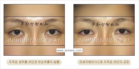 [두한성형외과 NO.1 눈성형] - [함몰된(꺼진) 눈꺼풀에서 쌍꺼풀 라인 교정 2.] 관련 이미지 10