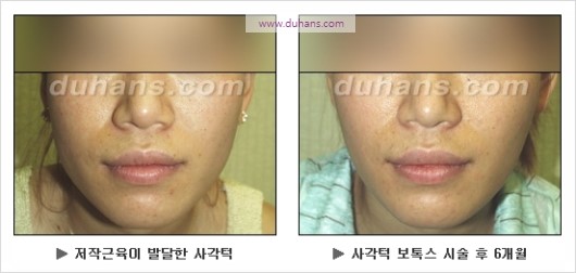 [두한성형외과 경쟁력 안면윤곽 성형 리더] - [완변한 V 라인! 턱 미세지방이식, 볼살 미세지방이식, 사각턱 보톡스 안내] 관련 이미지 35