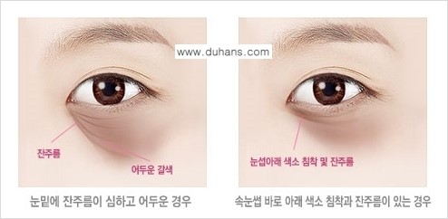 [두한성형외과 경쟁력 다크써클 치료] - [다크써클 5단계로 이뤄지는 핵심 5 STEP SOLUTION 안내 1.] 관련 이미지 7