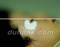 Duhan Plastic Surgery Laser Treatment - Mole Removal, Spot Removal, Melasma, Blemishes, Hyperpigmentation, Skin Tone Improvement, Elasticity Improvement, Skin Texture Improvement image 18