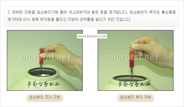 [두한성형외과 경쟁력 미세지방이식] - [입체 미세지방이식으로 주름을 펴면서 볼륨감 있는 입술 만들기] 관련 이미지 3