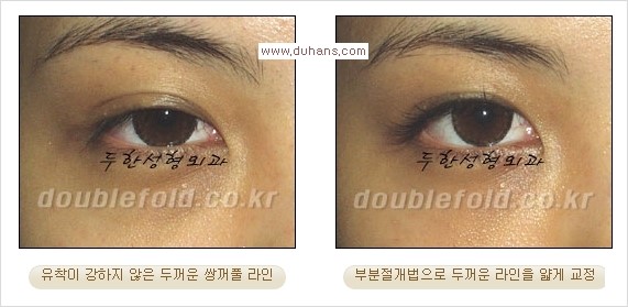 [두한성형외과 경쟁력 눈성형] - [부분절개법(Partial incision method)의 재수술 과정] 관련 이미지 12