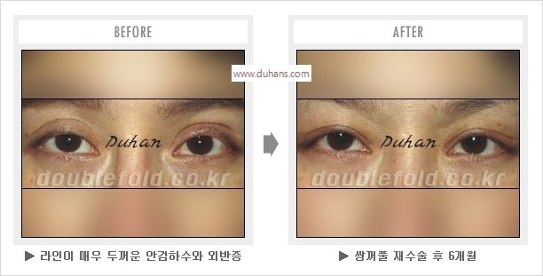 [두한성형외과 경쟁력 눈성형] - [나에게 맞는 어울리는 쌍꺼풀 라인] 관련 이미지 25