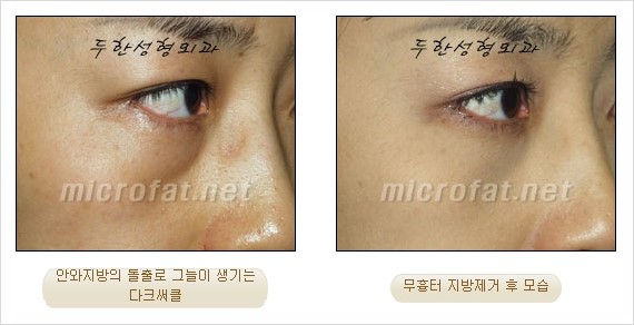 [두한성형외과 쌍커풀수술] - [눈성형 방법에 대한 자주하는 질문과 답변] 관련 이미지 193