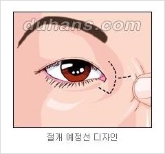[두한성형외과 경쟁력 눈성형] - [흉터없는 몽고주름 제거술(앞트임) 관련 이미지 6