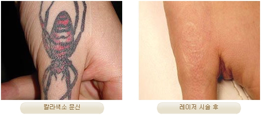 Duhan Plastic Surgery Laser Treatment - Mole Removal, Spot Removal, Melasma, Blemishes, Hyperpigmentation, Skin Tone Improvement, Elasticity Improvement, Skin Texture Improvement image 23