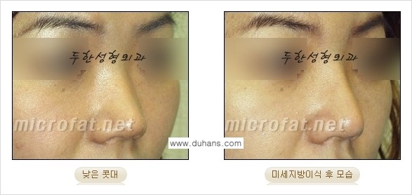 [두한성형외과 경쟁력 코성형] - [미세지방이식을 이용한 자연스러운 코성형 안내] 관련 이미지 15