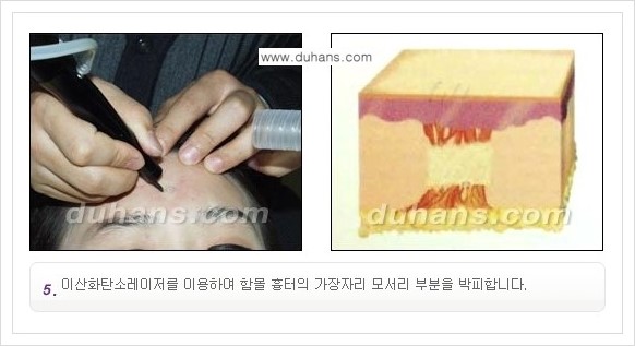 [두한성형외과 경쟁력 함몰 흉터 교정] - [동시에 3가지 시술로 효과적인 함몰 흉터 교정 안내] 관련 이미지 8