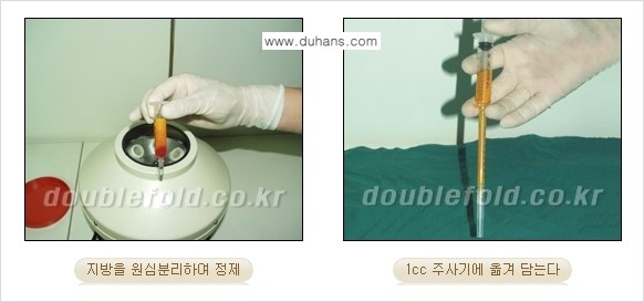 [두한성형외과 NO.1 눈성형] - [함몰된(꺼진) 눈꺼풀에서 쌍꺼풀 라인 교정 2.] 관련 이미지 2