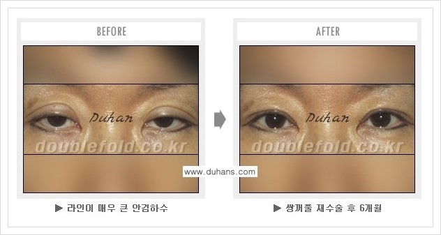 [두한성형외과 경쟁력 쌍꺼풀(눈) 재수술] - [쌍꺼풀 재수술시 잘못된 수술로 인한 넓어진 흉터 처리 안내] 관련 이미지 4