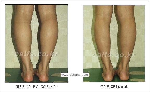 [두한성형외과 경쟁력 종아리성형] - [종아리 지방흡입 2.] 관련 이미지 6