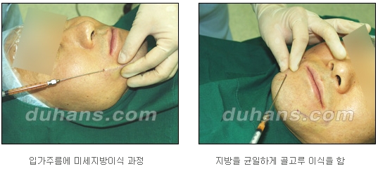 [두한성형외과 얼굴자가지방이식] - [지방이식 과정] 관련 이미지 17