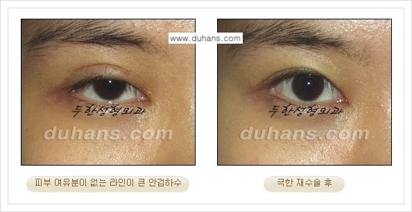 [두한성형외과 경쟁력 망가진 눈 복원수술] - [두꺼운 라인을 교정하는 극한 재수술(Extreme Reoperation) 안내] 관련 이미지 10