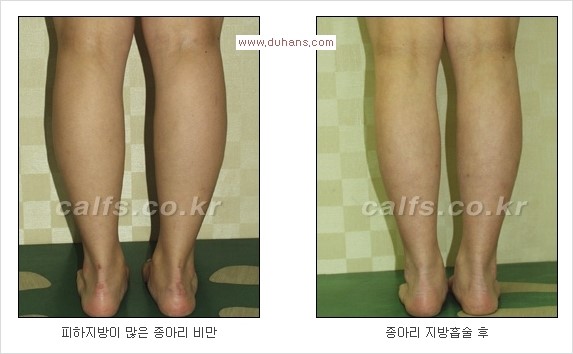⁠⁠[두한성형외과 경쟁력 멀티종아리성형] - [종아리성형 전후 주의해야 할 사항] 관련 이미지 10