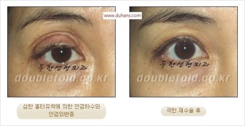 ​[두한성형외과 눈재수술] - [앞트임복원, 뒤트임복원, 쌍꺼풀복원] 관련 이미지 25