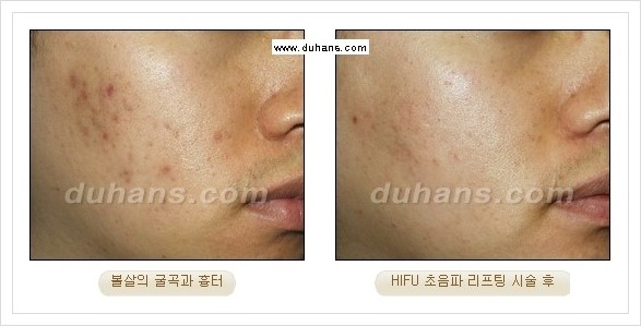 [두한성형외과 경쟁력 주름성형] - [HIFU 초음파 리프팅 주름교정술 안내 2.] 관련 이미지 23
