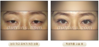 [두한성형외과 쌍커풀수술] - [매력적인 쌍커풀] 관련 이미지 20