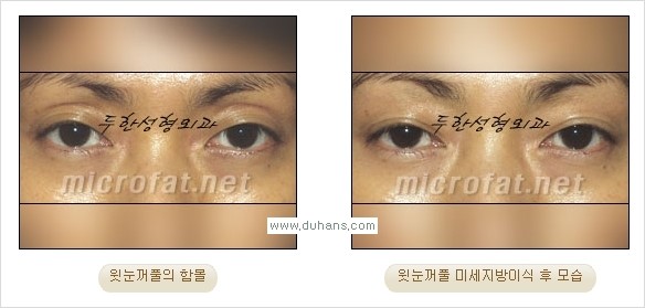 [두한성형외과 경쟁력 미세지방이식] - [꺼진(함몰된) 윗눈꺼풀 미세지방이식] 관련 이미지 10