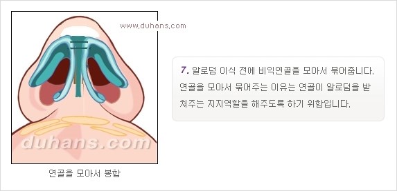[두한성형외과 경쟁력 코성형] - [코성형을 위한 알로덤(슈어덤) 수술, 실리콘 수술 안내] 관련 이미지 10