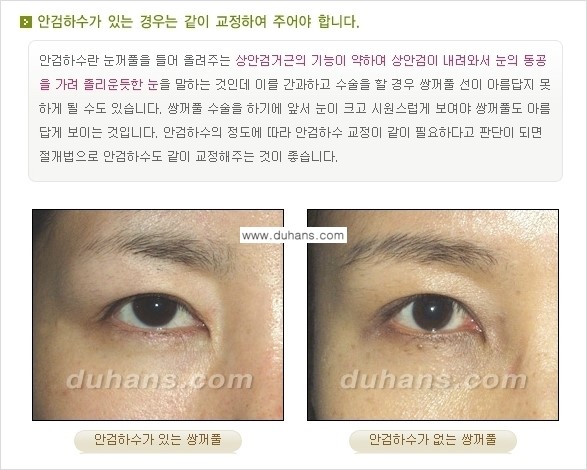 [두한성형외과 경쟁력 눈성형] - [매력적인 쌍꺼풀이란?] 관련 이미지 7