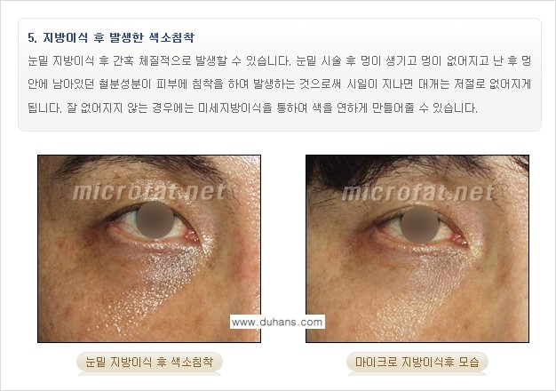 [두한성형외과 "미세지방이식"] - [지방이식 부작용 교정 정보 ③] 관련 이미지 5