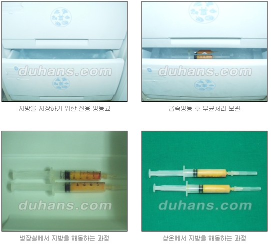 [두한성형외과 얼굴자가지방이식] - [지방이식 과정] 관련 이미지 19