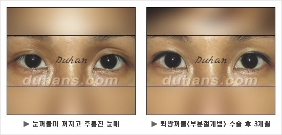 [두한성형외과 쌍커풀수술] - [눈성형 방법에 대한 자주하는 질문과 답변] 관련 이미지 114