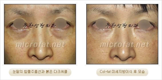 ​[두한성형외과 경쟁력 눈밑성형 리더] - [눈밑 다크써클의 증상, 원인, 종류, 치료방법 안내] 관련 이미지 40
