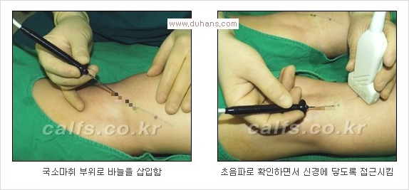 ⁠⁠[두한성형외과 경쟁력 종아리성형] - [굵은 다리의 모양과 원인에 따른 종아리성형 방법] 관련 이미지 6