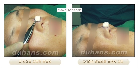 [두한성형외과 경쟁력 코성형] - [코성형을 위한 알로덤(슈어덤) 수술, 실리콘 수술 안내] 관련 이미지 2
