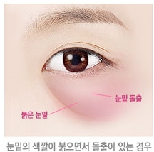 두한성형외과 눈밑수술 - 다크서클 수술 전후 관리 안내 관련 이미지 105