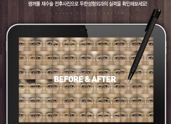 Double Eyelid Revision Surgery at Duhan Plastic Surgery Clinic - Asymmetric Double Eyelids, Pseudoptosis, and Lateral/Lower Canthoplasty image 51