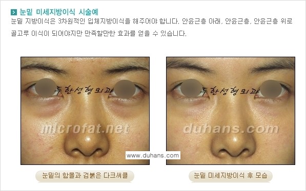 [두한성형외과 상큼하고 환한 눈매완성] - [눈밑 미세지방이식 ①] 관련 이미지 2