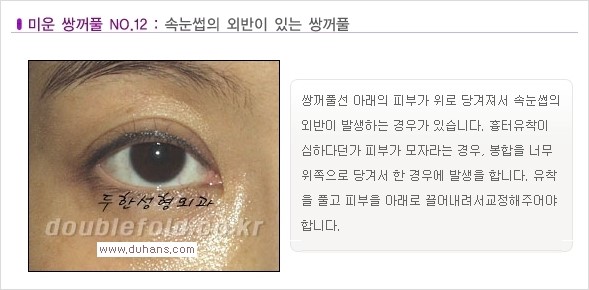 [두한성형외과 경쟁력 쌍꺼풀 재수술, 극한 재수술] - [일반적인 기준의 미운 쌍꺼풀과 아름다운 쌍꺼풀 안내] 관련 이미지 12