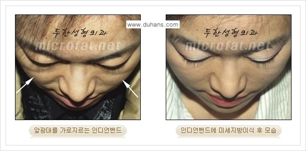 [두한성형외과 경쟁력 미세지방이식] - [귀족수술과 인디언밴드 교정 안내] 관련 이미지 17