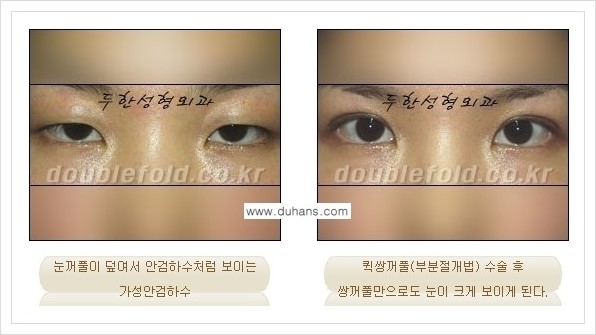 [두한성형외과 경쟁력 쌍꺼풀 재수술, 극한 재수술] - [안검하수(졸린눈매) 교정 방법 안내] 관련 이미지 11