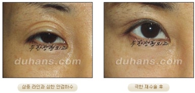 [Special Double Eyelid Revision Surgery at Duhan Plastic Surgery] - [Restorative Surgery for Damaged Double Eyelid Eye Shape] image 26
