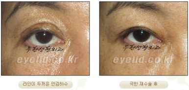 Duhan Plastic Surgery Ophthalmic Reoperation - What Is a Successful Double Eyelid Revision Surgery? image 10