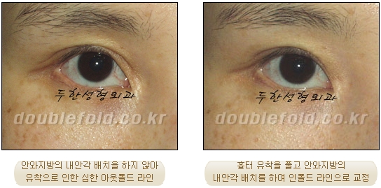 [두한성형외과 쌍수] - [재수술 실패의 원인, 재수술의 성공 요건] 관련 이미지 9