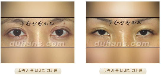 두한성형외과 눈재수술 - 쌍꺼풀 재수술 방법 관련 이미지 8