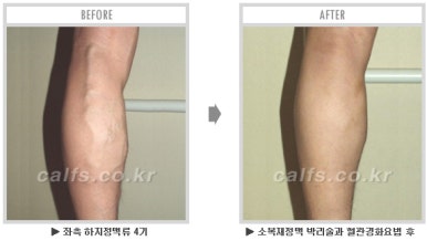 ​[두한성형외과 종아리수술] - [나에게 맞는 종아리성형방법] 관련 이미지 44