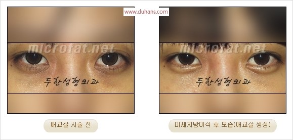 ​﻿[두한성형외과 경쟁력 지방이식] - [눈밑 애교살 시술을 위한 미세지방이식] 관련 이미지 40