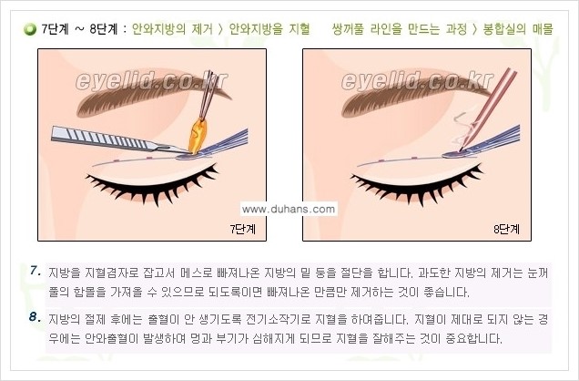 [두한성형외과 경쟁력 눈성형] - [퀵쌍꺼풀 수술] 관련 이미지 5