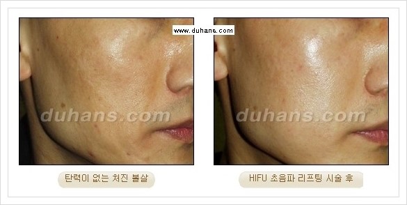 [두한성형외과 경쟁력 주름성형] - [HIFU 초음파 리프팅 주름교정술 안내 2.] 관련 이미지 24