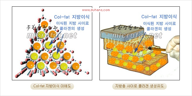 [두한성형외과 Dr. 컬럼] - [콜펫(Col-fat) 지방이식 - 터널링기법, 미세지방이식, 다층지방이식] 관련 이미지 1